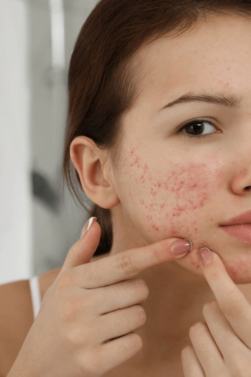 natural skin care for acne